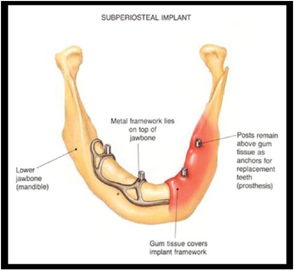 Illustration of jaw with focus on Dental Implants Treatment in Indore.